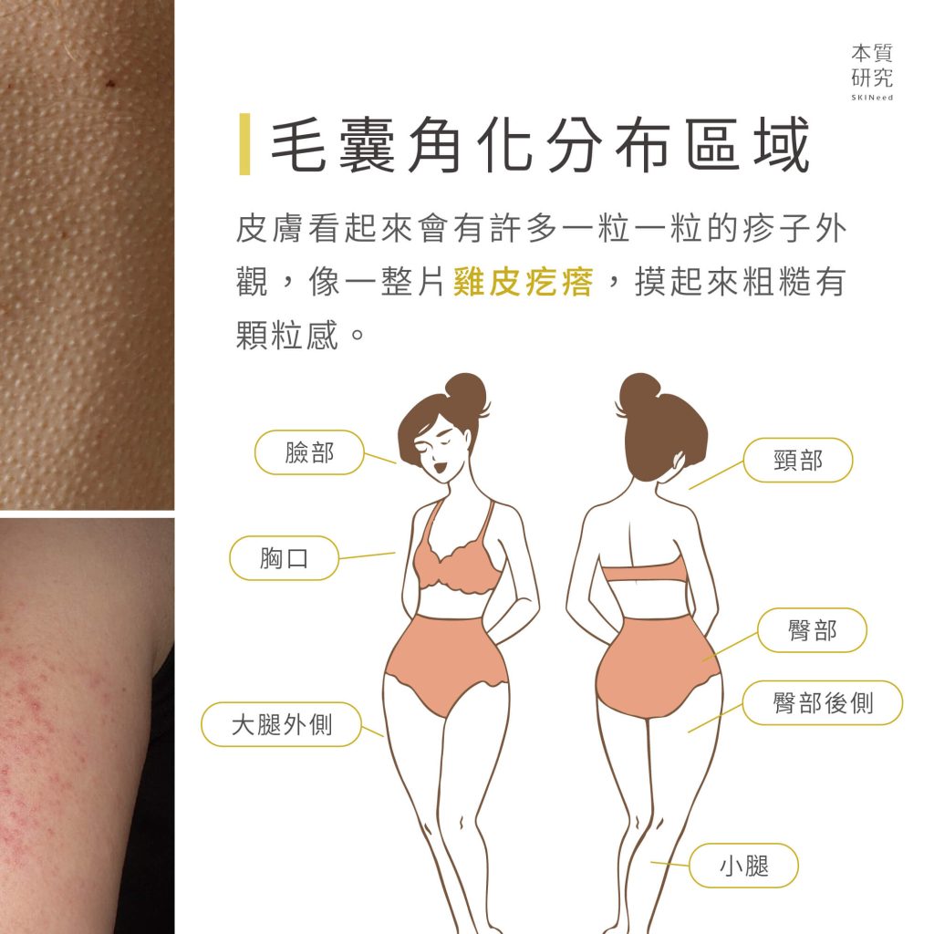 毛囊角化症怎麼治療？一次彙整成因、症狀與 6 大保養改善建議-圖2
